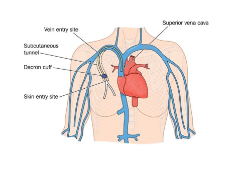 Central Venous Catheter Placement by OrangeCountySurgeons